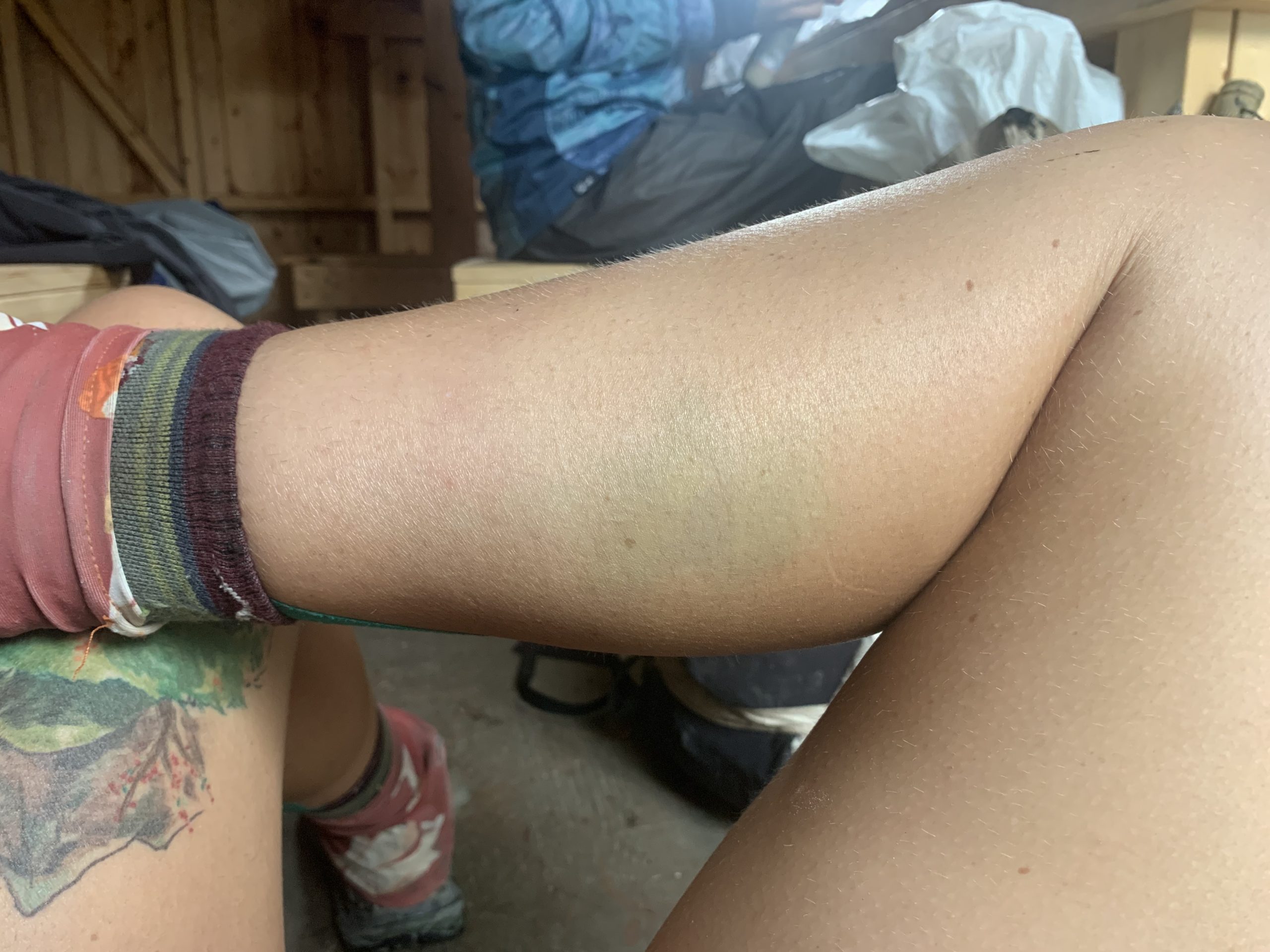 Severe purple and yellow bruising on a person's calf muscle.